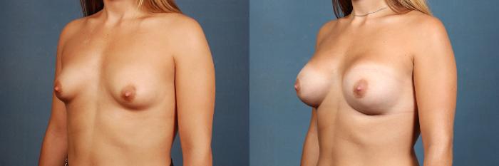 Before & After Enlargement - Silicone Case 317 View #2 View in Louisville & Lexington, KY