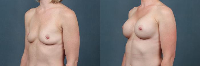 Before & After Enlargement - Silicone Case 330 View #2 View in Louisville & Lexington, KY