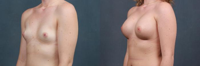 Before & After Enlargement - Silicone Case 335 View #2 View in Louisville & Lexington, KY