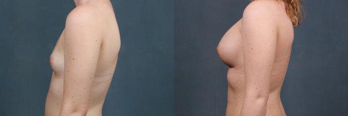 Before & After Enlargement - Silicone Case 335 View #3 View in Louisville & Lexington, KY