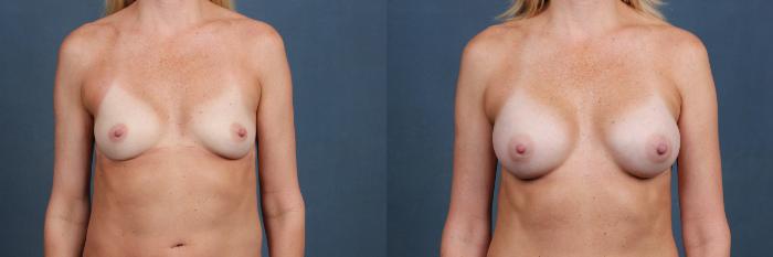 Before & After Enlargement - Silicone Case 375 View #1 View in Louisville & Lexington, KY