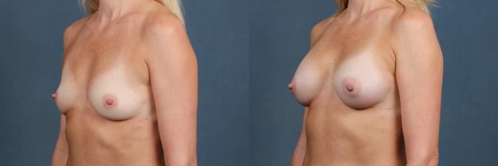 Before & After Enlargement - Silicone Case 375 View #2 View in Louisville & Lexington, KY