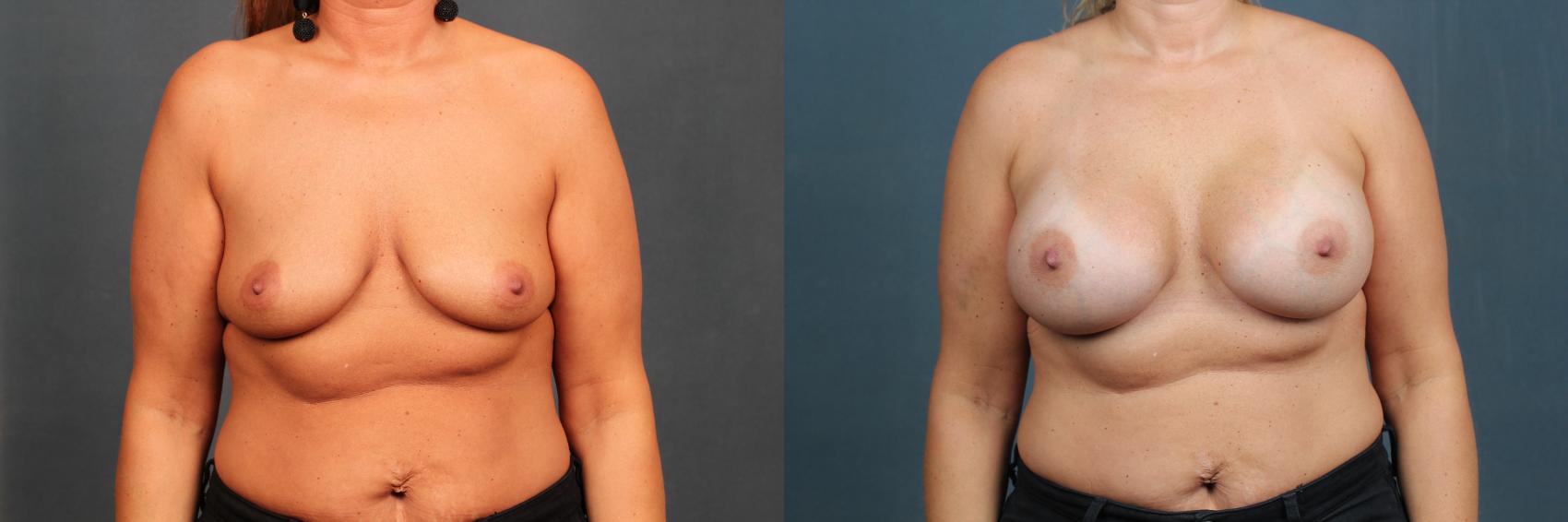 Before & After Enlargement - Silicone Case 591 View #1 View in Louisville & Lexington, KY