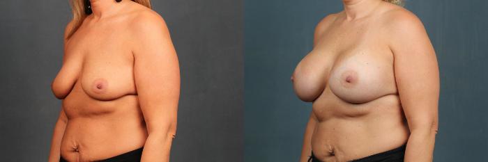 Before & After Enlargement - Silicone Case 591 View #2 View in Louisville & Lexington, KY