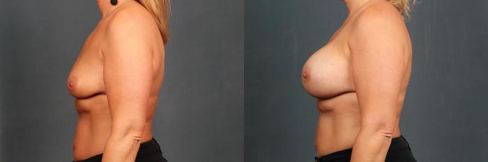 Before & After Enlargement - Silicone Case 591 View #3 View in Louisville & Lexington, KY