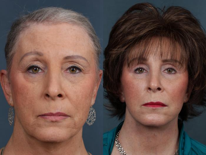 Before & After Eyelid Surgery Case 512 View #1 View in Louisville & Lexington, KY