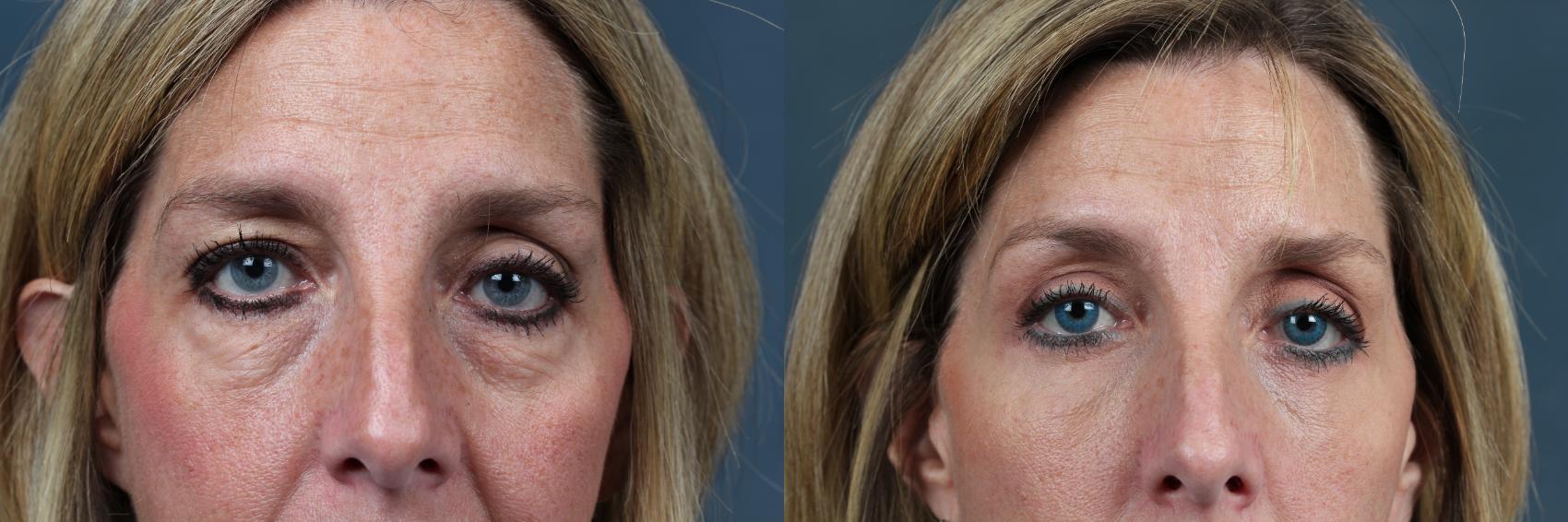 Before & After Eyelid Surgery Case 578 View #1 View in Louisville & Lexington, KY