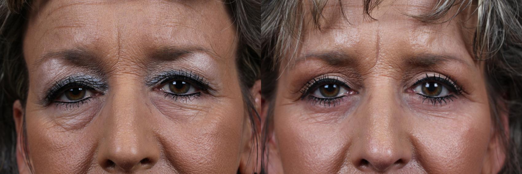 Before & After Eyelid Surgery Case 582 View #1 View in Louisville & Lexington, KY