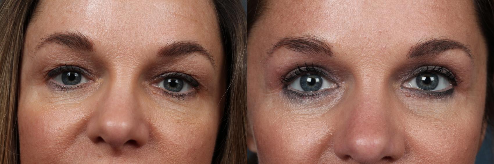 Before & After Eyelid Surgery Case 585 View #1 View in Louisville & Lexington, KY
