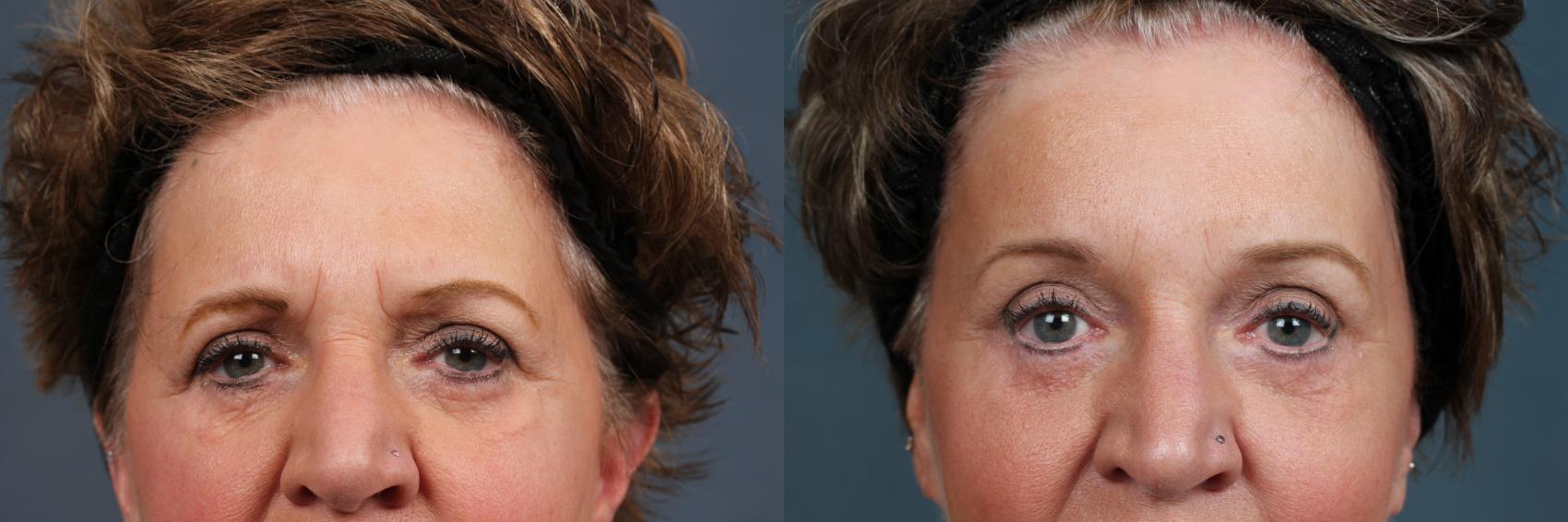 Before & After Eyelid Surgery Case 605 View #1 View in Louisville & Lexington, KY