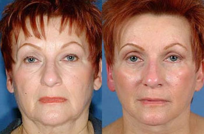 Before & After Eyelid Surgery Case 65 View #1 View in Louisville & Lexington, KY