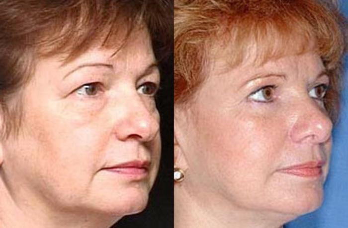 Before & After Eyelid Surgery Case 66 View #2 View in Louisville & Lexington, KY