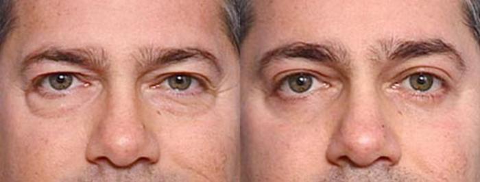 Before & After Eyelid Surgery Case 80 View #1 View in Louisville & Lexington, KY