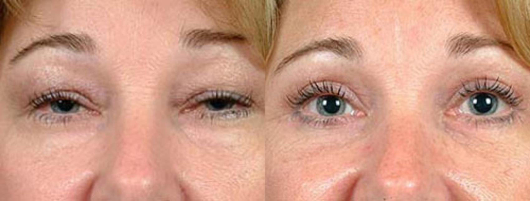 Before & After Eyelid Surgery Case 81 View #1 View in Louisville & Lexington, KY