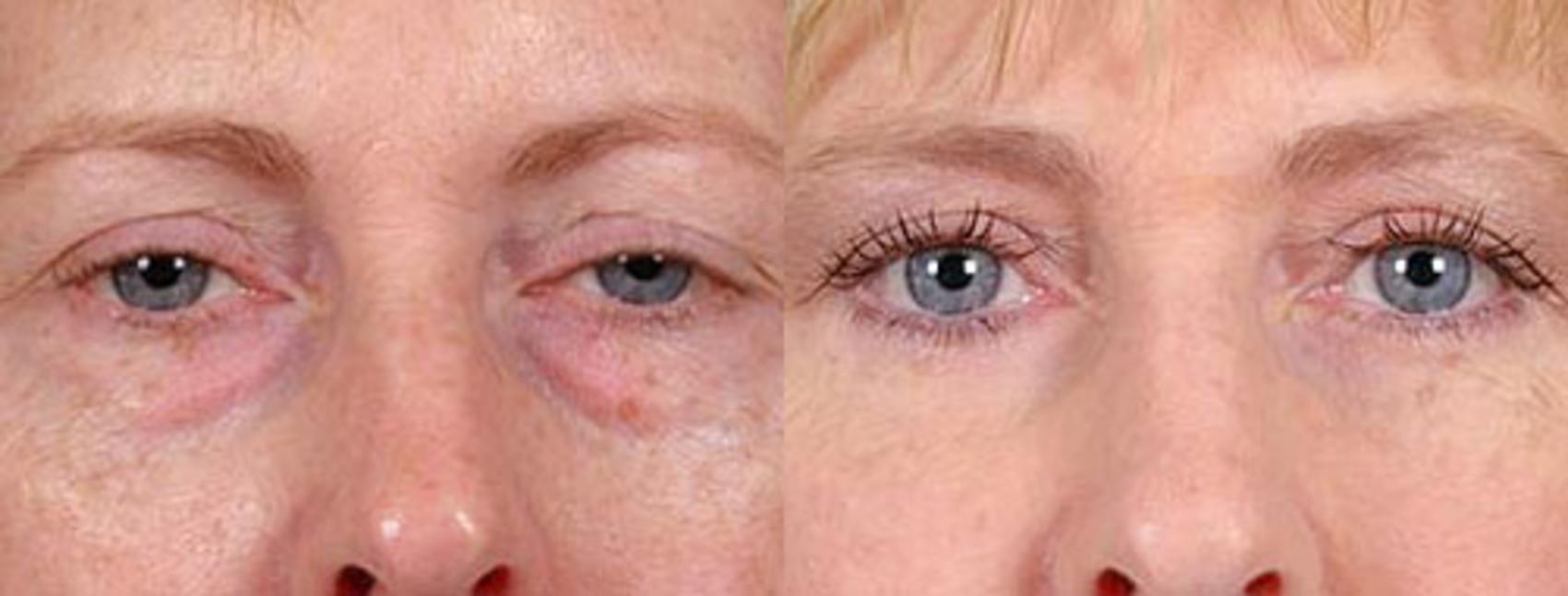 Before & After Eyelid Surgery Case 83 View #1 View in Louisville & Lexington, KY