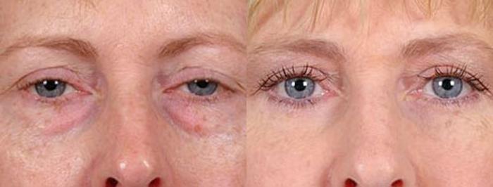 Before & After Eyelid Surgery Case 83 View #1 View in Louisville & Lexington, KY