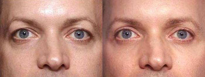 Before & After Eyelid Surgery Case 84 View #1 View in Louisville & Lexington, KY