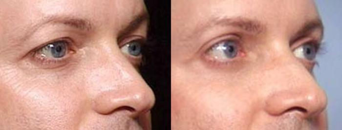 Before & After Eyelid Surgery Case 84 View #2 View in Louisville & Lexington, KY