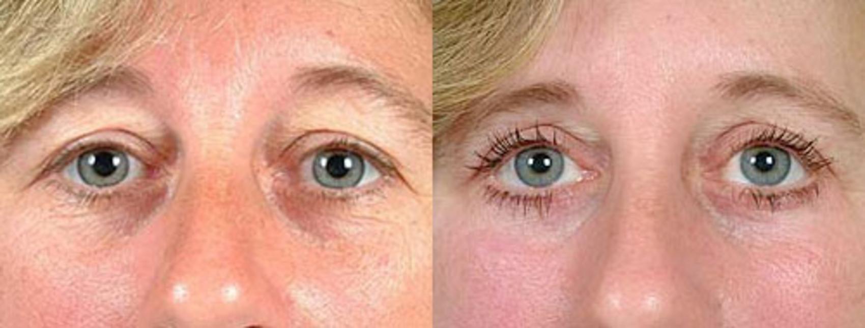 Before & After Eyelid Surgery Case 88 View #1 View in Louisville & Lexington, KY