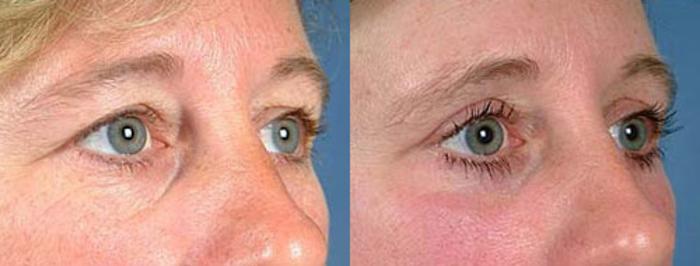 Before & After Eyelid Surgery Case 88 View #2 View in Louisville & Lexington, KY