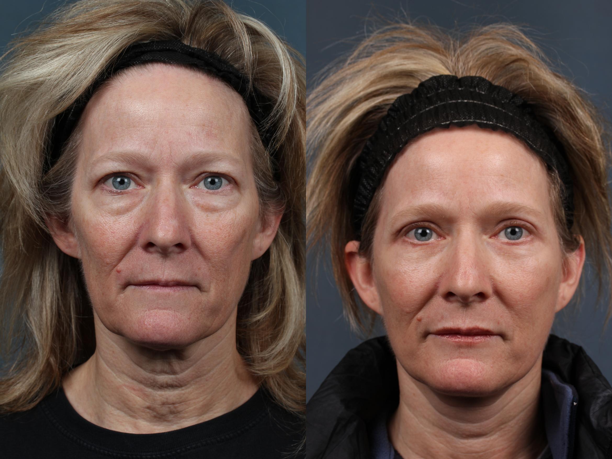 Facelift Case 495 Before & After View #1 | Louisville, KY | CaloAesthetics® Plastic Surgery Center
