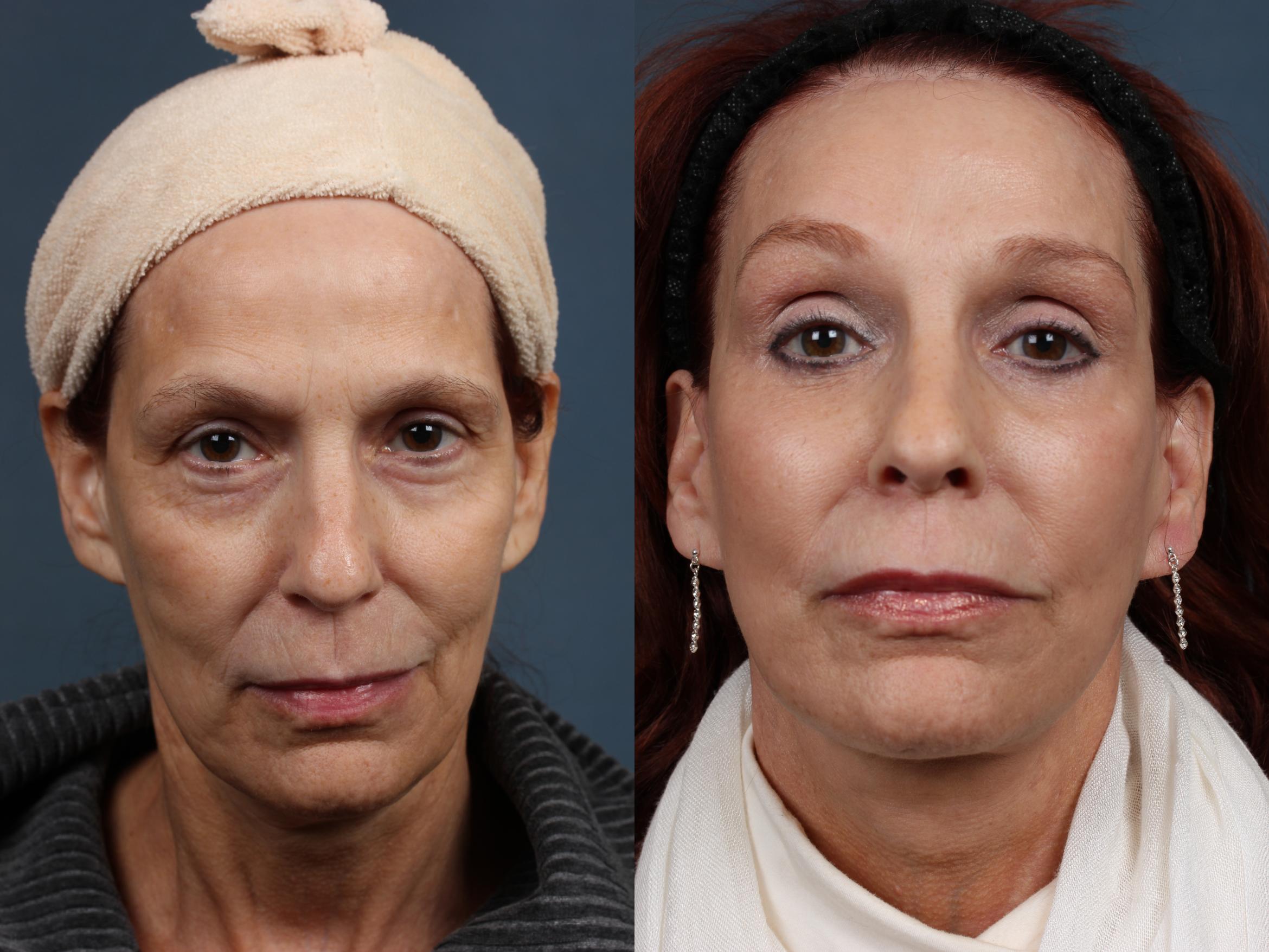 Before & After Facelift Case 509 View #1 View in Louisville & Lexington, KY