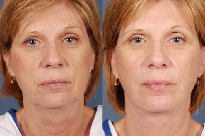 Before & After Facelift Case 237 View #1 View in Louisville & Lexington, KY