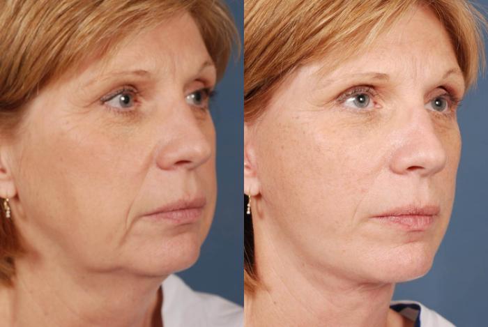 Before & After Facelift Case 237 View #2 View in Louisville & Lexington, KY