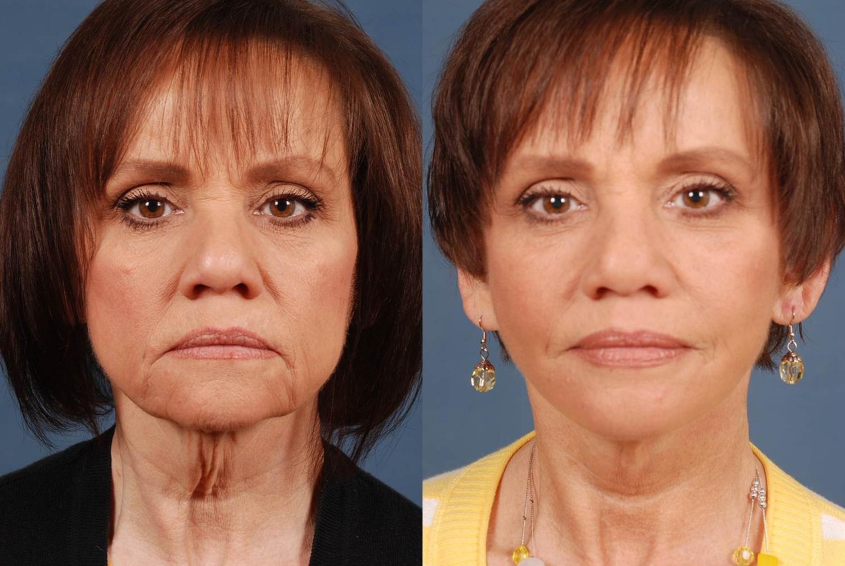 Before & After Facelift Case 238 View #1 View in Louisville & Lexington, KY