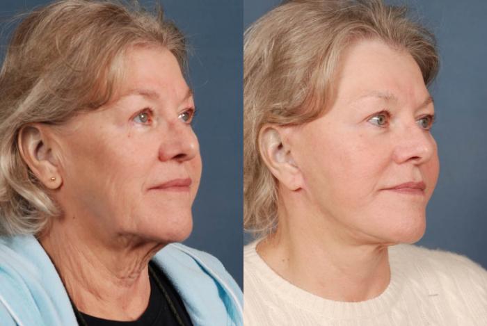 Before & After Facelift Case 239 View #2 View in Louisville & Lexington, KY