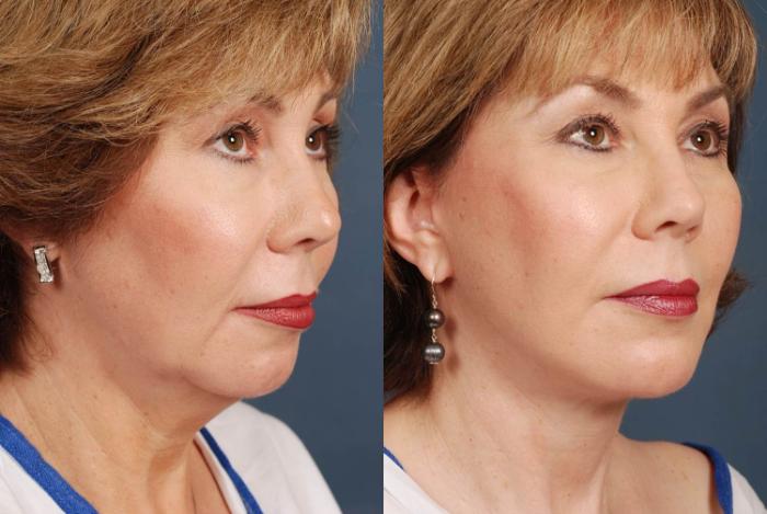 Before & After Facelift Case 240 View #2 View in Louisville & Lexington, KY