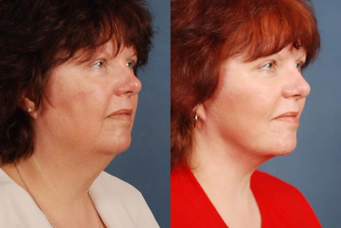 Before & After Facelift Case 241 View #2 View in Louisville & Lexington, KY