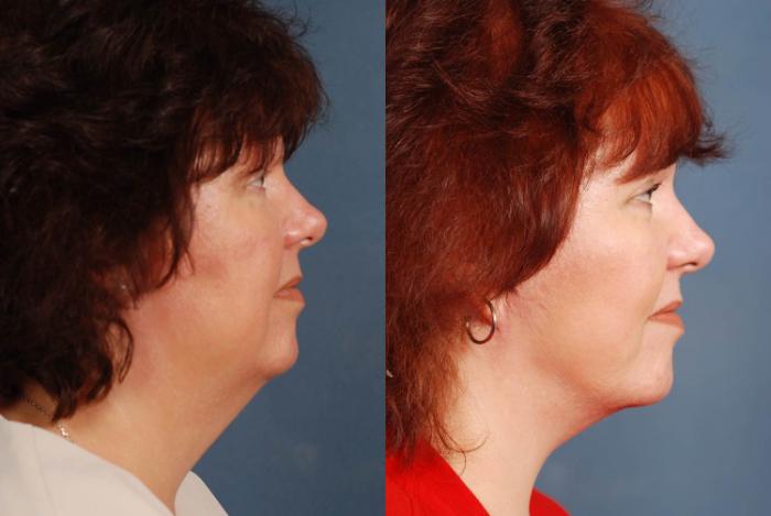 Before & After Facelift Case 241 View #3 View in Louisville & Lexington, KY