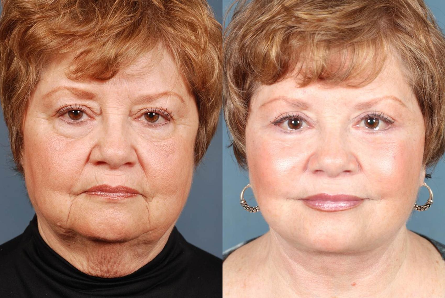 Before & After Facelift Case 242 View #1 View in Louisville & Lexington, KY