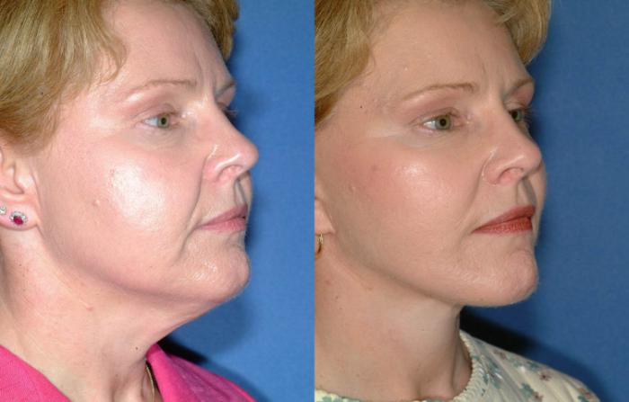 Before & After Facelift Case 244 View #2 View in Louisville & Lexington, KY