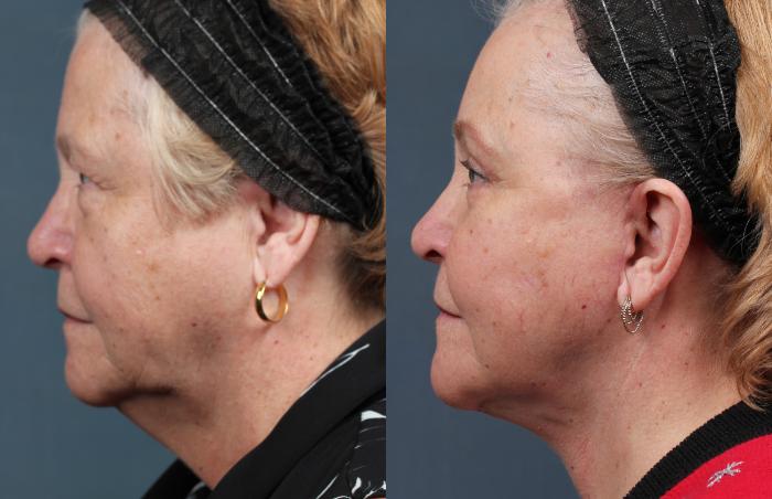 Before & After Facelift Case 282 View #2 View in Louisville & Lexington, KY