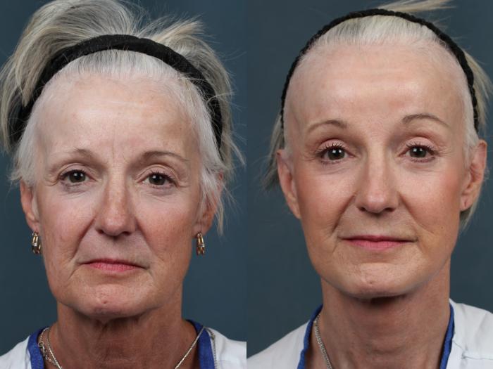 Before & After Facelift Case 491 View #1 View in Louisville & Lexington, KY