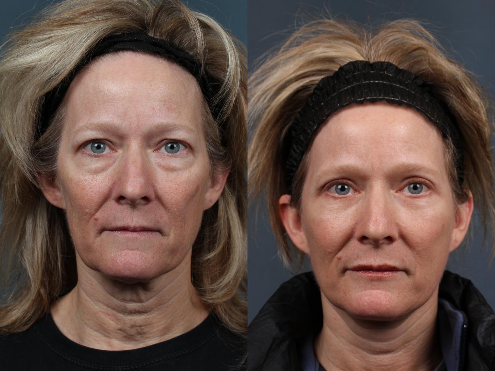 Before & After Facelift Case 495 View #1 View in Louisville & Lexington, KY