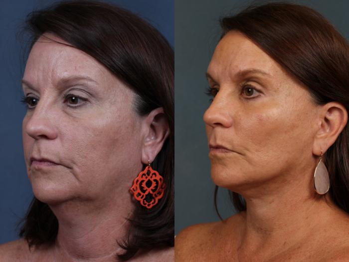 Before & After Facelift Case 496 View #2 View in Louisville & Lexington, KY