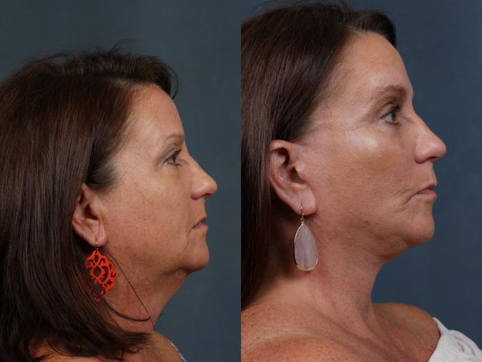 Before & After Facelift Case 496 View #3 View in Louisville & Lexington, KY