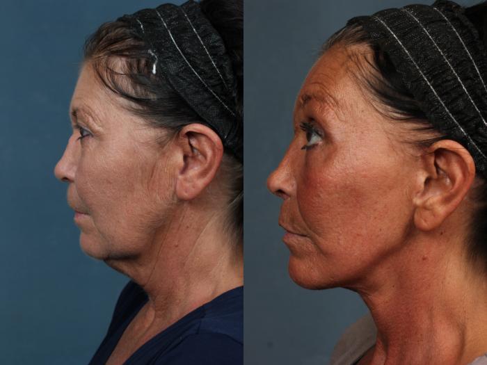 Before & After Facelift Case 497 View #2 View in Louisville & Lexington, KY