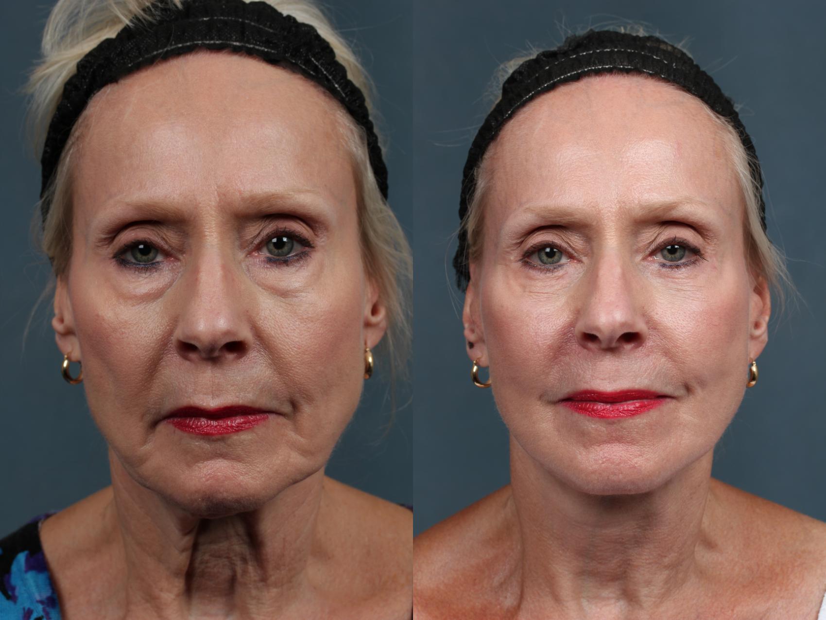 Before & After Facelift Case 498 View #1 View in Louisville & Lexington, KY