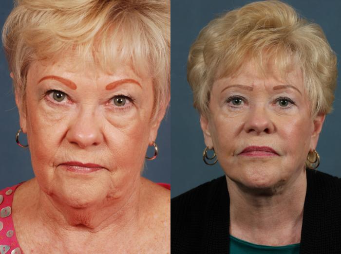 Before & After Facelift Case 500 View #1 View in Louisville & Lexington, KY