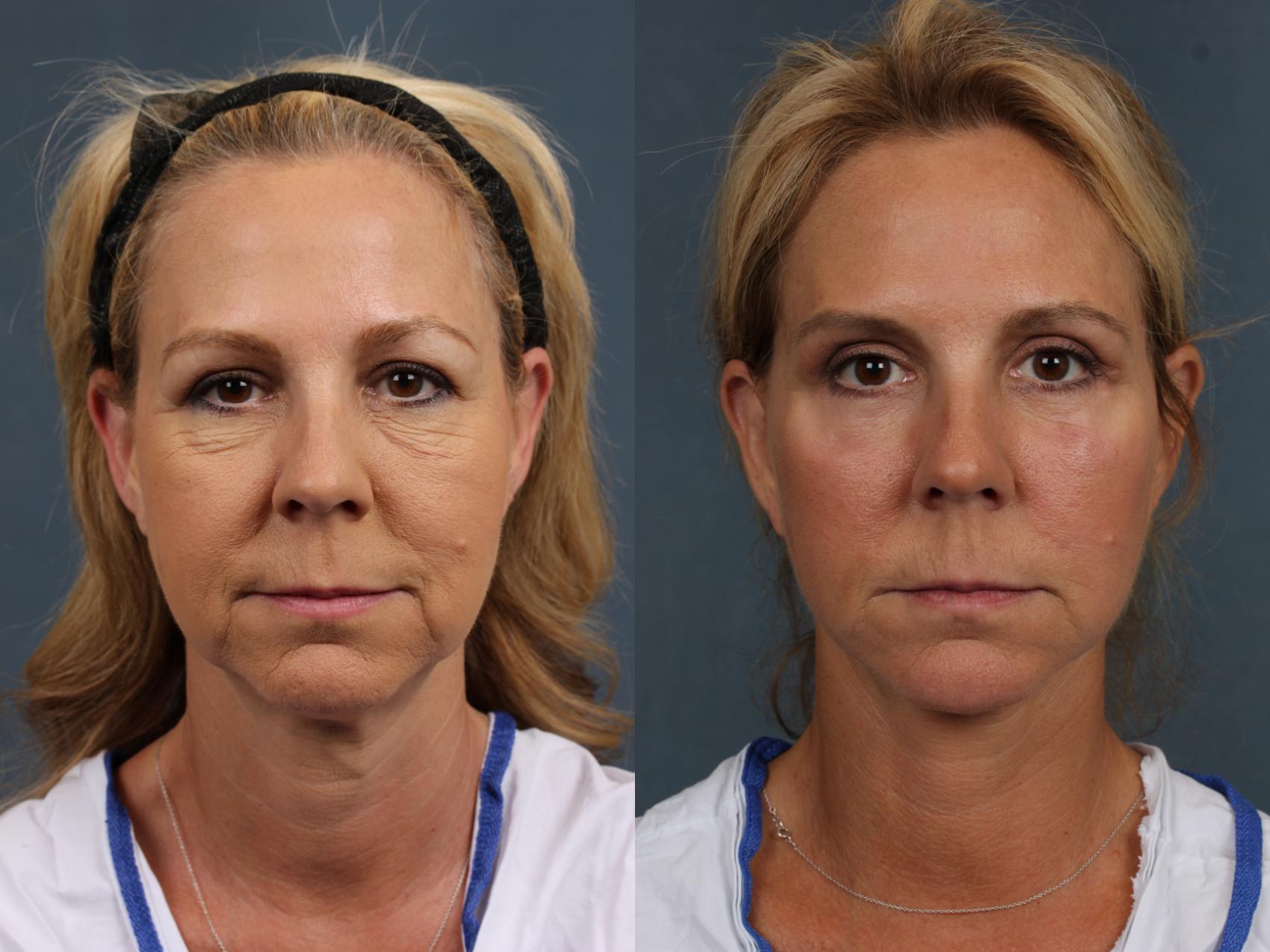 Before & After Facelift Case 501 View #1 View in Louisville & Lexington, KY