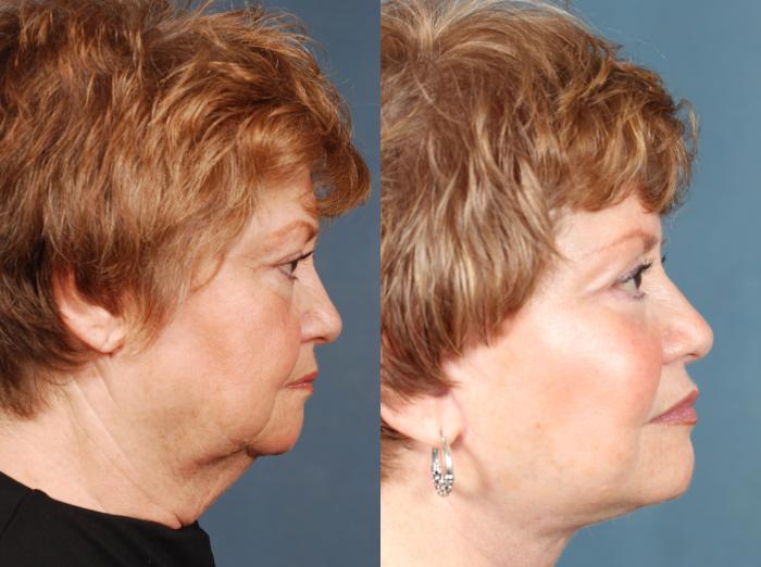 Before & After Facelift Case 502 View #3 View in Louisville & Lexington, KY