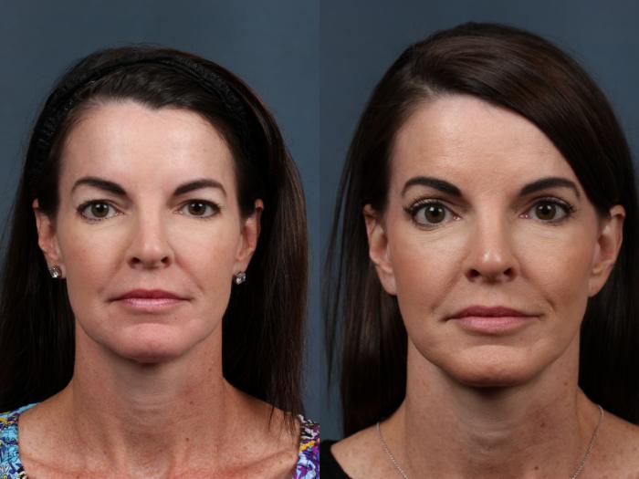 Before & After Facelift Case 503 View #1 View in Louisville & Lexington, KY