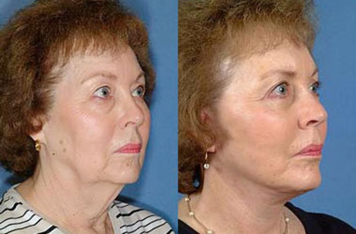 Before & After Facelift Case 61 View #2 View in Louisville & Lexington, KY