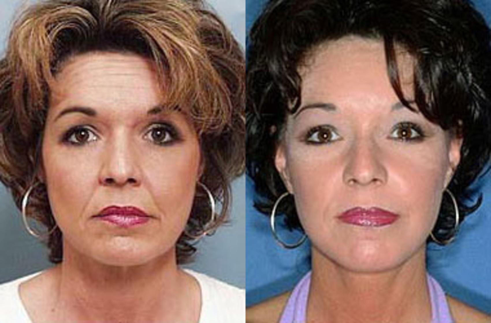 Before & After Facelift Case 63 View #1 View in Louisville & Lexington, KY