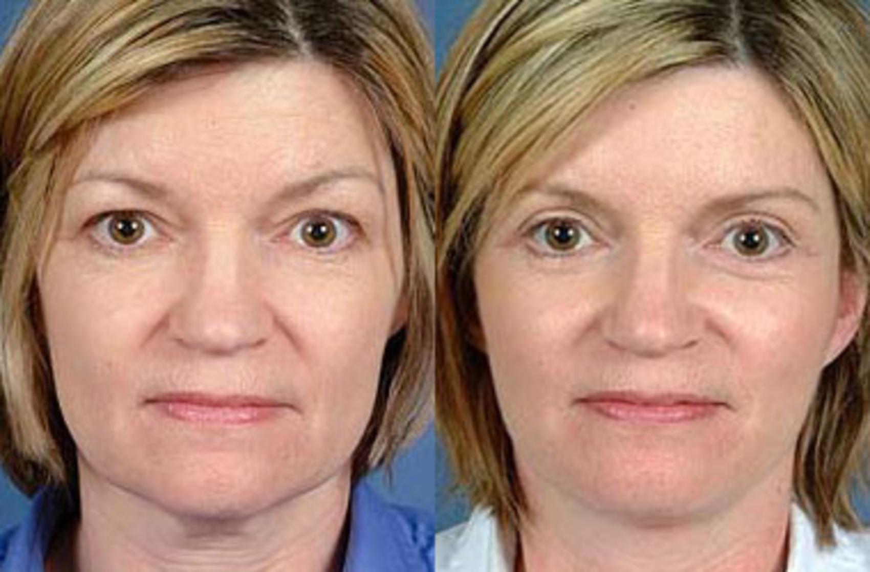 Before & After Facelift Case 68 View #1 View in Louisville & Lexington, KY