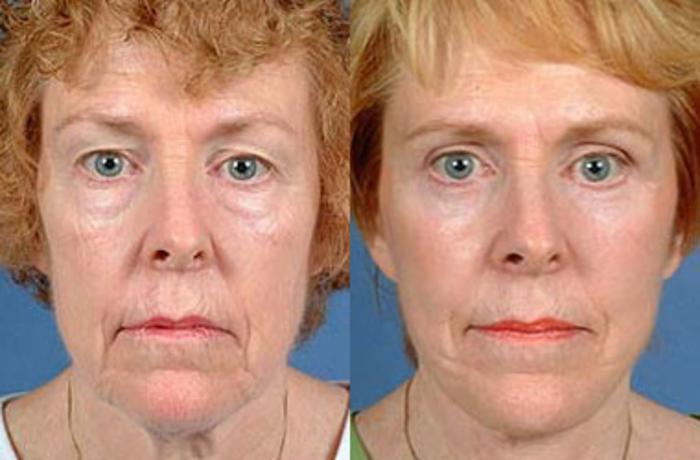 Before & After Facelift Case 69 View #1 View in Louisville & Lexington, KY
